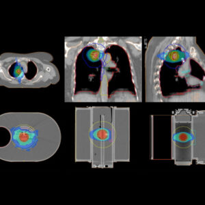 RADIATION THERAPY FILMS
